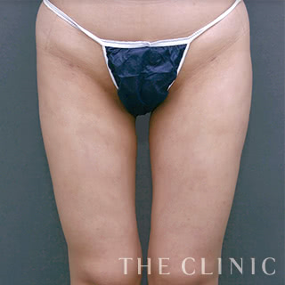 症例写真 / ベイザー脂肪吸引 術後