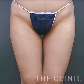 症例写真 / ベイザー脂肪吸引 術前