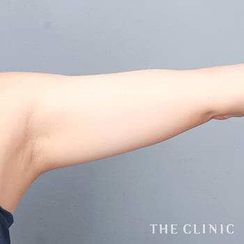 症例写真 / ベイザー脂肪吸引 術前