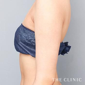 症例写真 / ベイザー脂肪吸引 術後