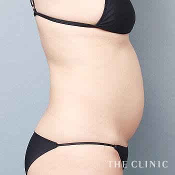 症例写真 / ベイザー脂肪吸引 術前