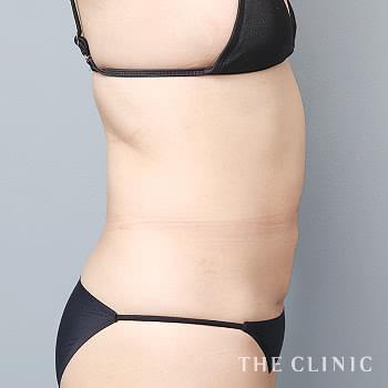 症例写真 / ベイザー脂肪吸引 術後