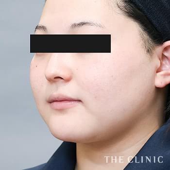 症例写真 / ベイザー脂肪吸引 術前