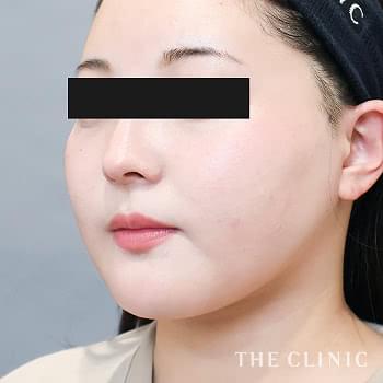 症例写真 / ベイザー脂肪吸引 術後