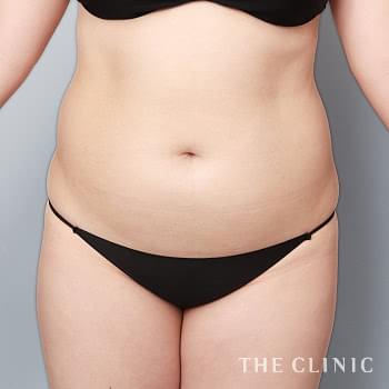 症例写真 / 360°脂肪吸引 術前