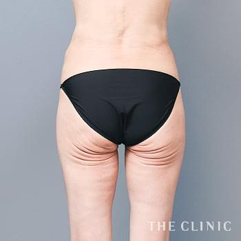 症例写真 / モフィウスボディ 術前