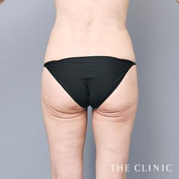 症例写真 / モフィウスボディ 術後