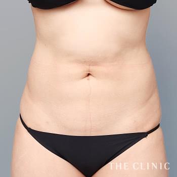 症例写真 / 他院の脂肪吸引修正 術前