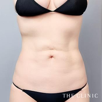 症例写真 / 他院の脂肪吸引修正 術前