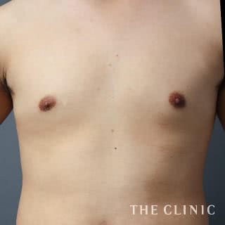 症例写真 / 女性化乳房治療(男性の胸の膨らみ改善) 術後