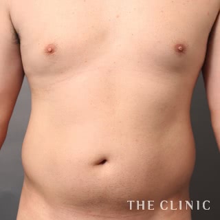 症例写真 / ベイザー4D(男性のシックスパック脂肪吸引) 術前
