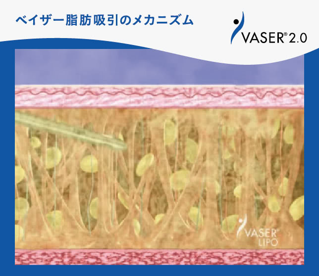 ベイザー脂肪吸引のメカニズム